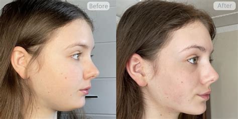 face yoga before and after reddit|nose yoga before and after.